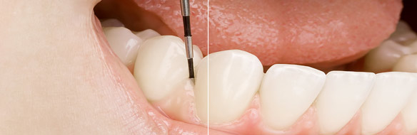Systematic parodontal treatment